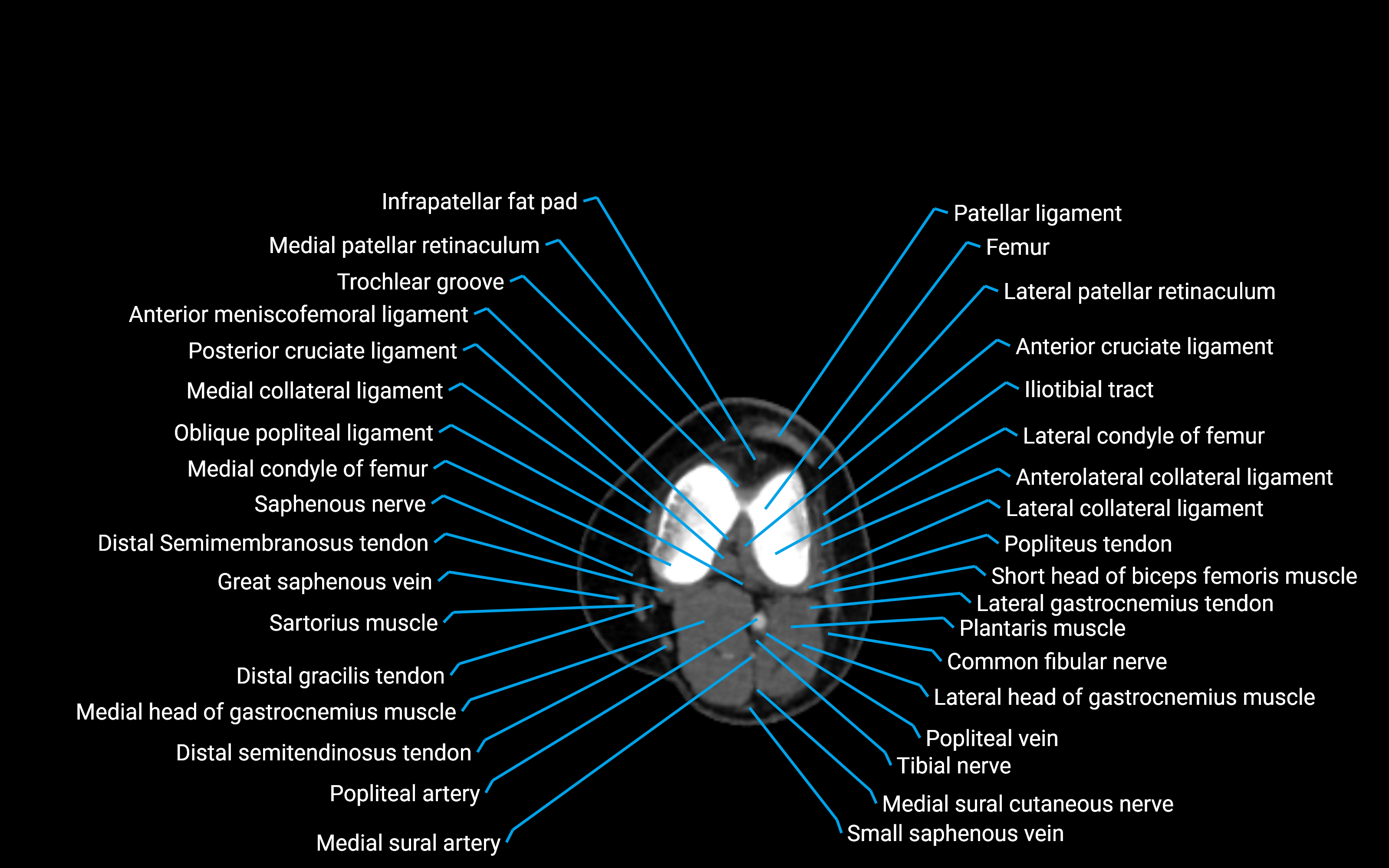 CT Lower leg axial cross sectional anatomy labelled image 89 (2).png